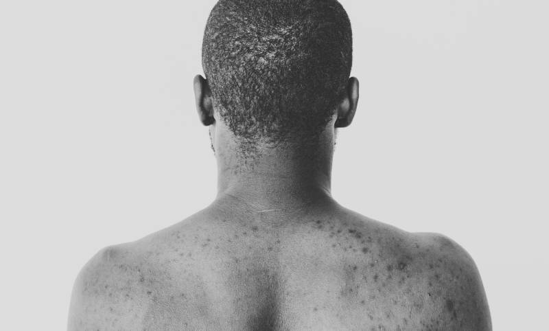 Sciatique douloureuse : un ostéopathe peut vous aider à Ambarès-et-Lagrave ou Beychac-et-Caillau